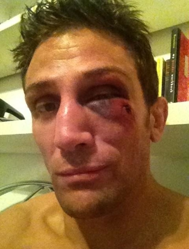 Alex Reid shows off his black eye