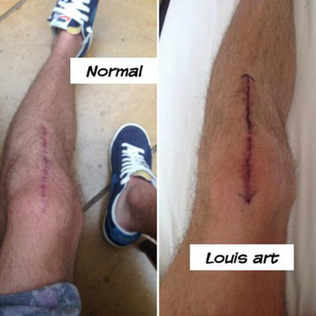 Niall Horan's leg after his knee surgery - and after Louis Tomlinson has coloured it in for fun, 27 April 2014
