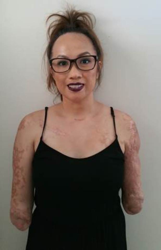 Karen without her prosthetic limbs
